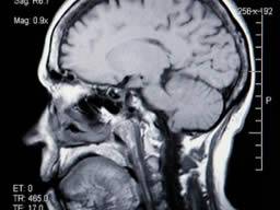1 miliarda dolaru rocne je venována kontrole mozku u pacientu s bolestmi hlavy