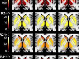 Abnormální hladiny zeleza v mozku "mohou být biomarkerem ADHD"
