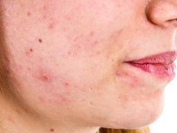 Akne kann durch ein Ungleichgewicht von Hautbakterien verursacht werden