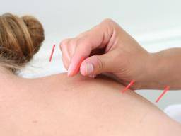 Akupunktur Rückenschmerzen Erfolg durch psychologische Faktoren bestimmt