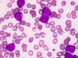 Leucémie myéloïde aiguë: ce que vous devez savoir