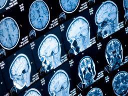 ADHS: Große bildgebende Studie bestätigt Unterschiede in mehreren Hirnregionen