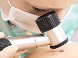 Isplestine melanoma: naujoviski bandymai gali pakeisti gydyma