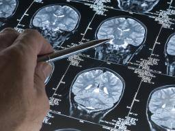 Algoritmus mohl predpovedet Alzheimerovu rizikovou dobu pred vznikem príznaku
