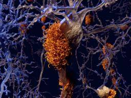 Alzheimerova droga slibuje pacienty ve studii III. Fáze