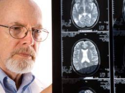 Alzheimerovy znaky se lisí napríc závody