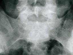Ankylosierende Spondylitis: Röntgen- und bildgebende Verfahren