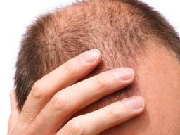 Lécba artritidy pomáhá plesatému cloveku rozvinout plnou hlavu vlasu
