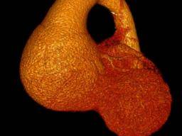 Anévrisme aortique ascendant: ce que vous devez savoir