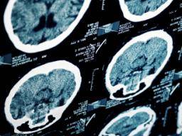 Das Bewusstsein für den "plötzlichen unerwarteten Tod bei Epilepsie" ist bei Patienten gering