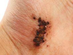 Les bactéries vivant sur la peau peuvent affecter la guérison des plaies