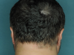 Plesatost vylécená lékem proti chorobe kostní drene u pacientu s alopecií areata