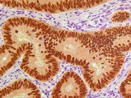 Biomarqueur prédit le résultat probable de la chimiothérapie pour les patients atteints d'un cancer du côlon de stade 2