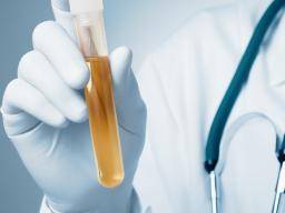 Cancer de la vessie: étapes non invasives de test d'urine de plus près