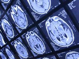 Gehirnanomalien bei Menschen mit Gehirnerschütterungen ähnlich denen mit Alzheimer
