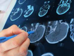 Mozgové tumory: Výzkumníci krupobití rozpustným aspirinem jako mozný prulom