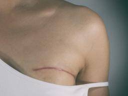 Prulom: relaps rakoviny prsu spojený s metabolismem tuku