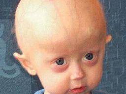 Ursachen, Symptome und Behandlung von Progerie