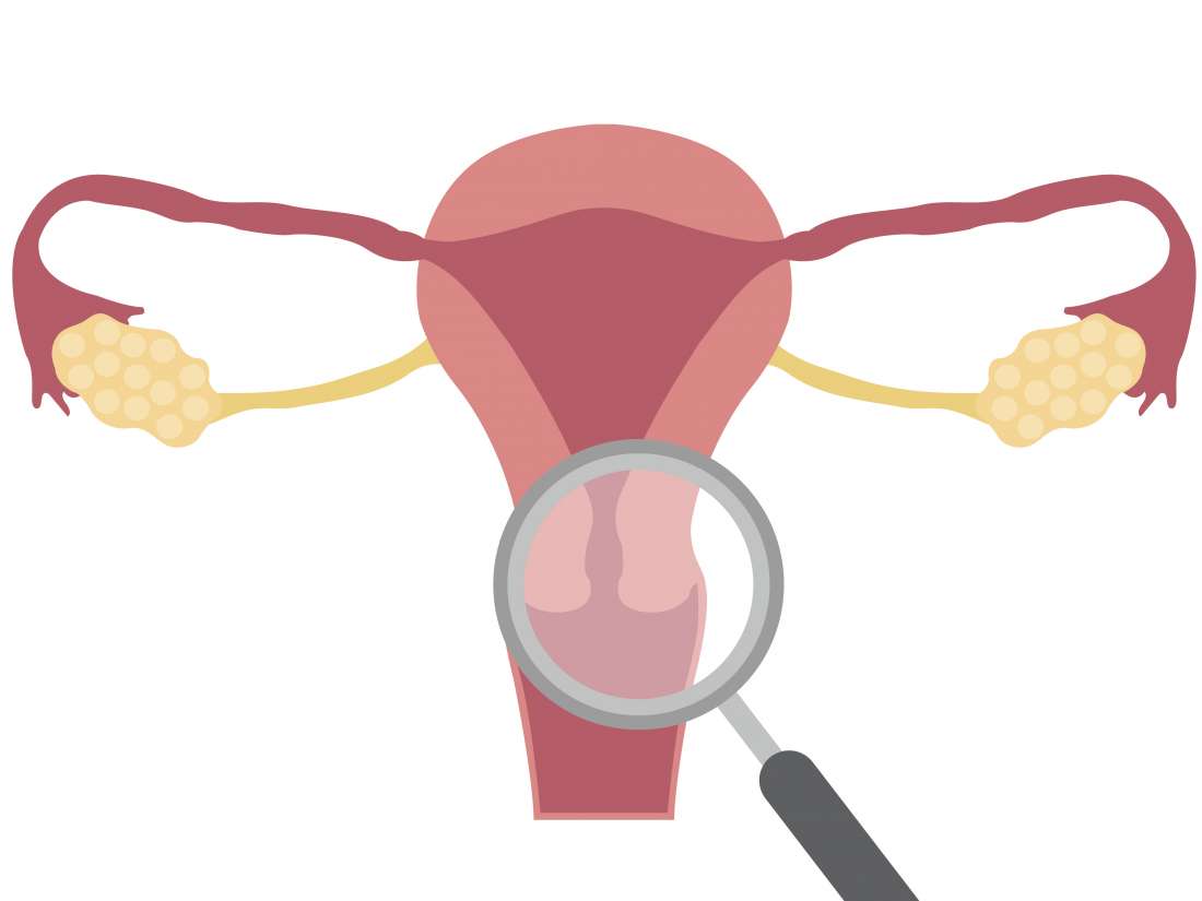 Ectropión cervical: lo que necesitas saber