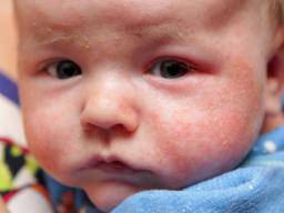 Klinická studie neprokázala zádné výhody nosení hedvábí pro deti s ekzémem