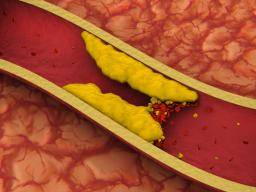 Les artères obstruées peuvent être dues aux bactéries, pas au régime