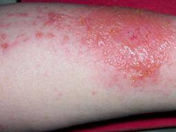 Dermatite de contact: déclencheurs et traitement
