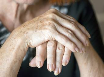 ¿Podría la vitamina D ayudar a mantener a raya la artritis reumatoide?