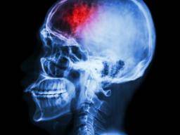 Les inhibiteurs de la COX-2 liés à un risque accru de décès par accident vasculaire cérébral