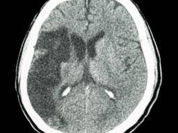 CT-Scans können das Risiko eines Schlaganfalls bei TIA-Patienten vorhersagen