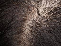 Cushing-Syndrom: Könnte die Analyse der Haare die Diagnose bestätigen?