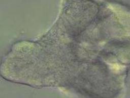 La recherche sur la fibrose kystique bénéficiera des «mini-poumons» cultivés en laboratoire