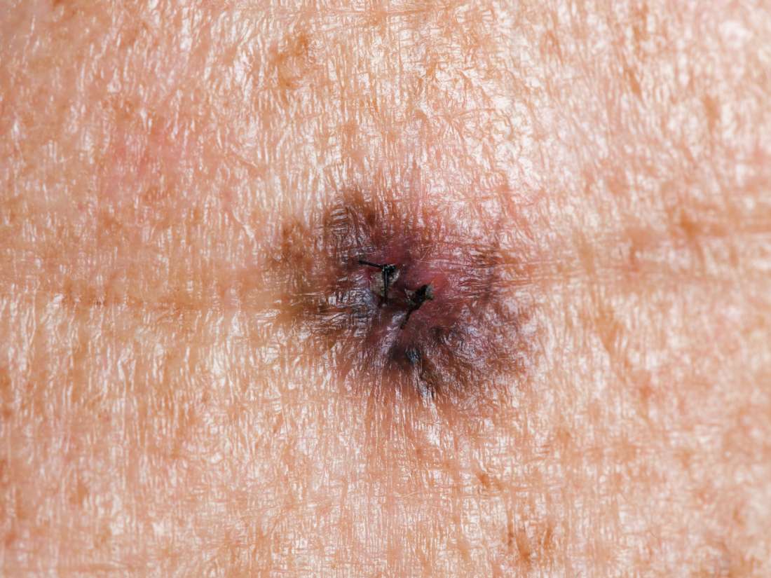 El cáncer de piel mortal podría detenerse con la artritis