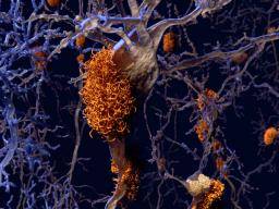 Die Unterbrechung der Protein-Interaktion kann die Progression von Alzheimer verlangsamen