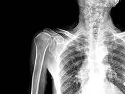 Frühe zystische Fibrose mit bronchoalveolärer Lavage und Lungen-Clearance-Index nachgewiesen