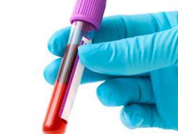 Selon une étude, la détection précoce de l’arthrose par test sanguin en vue