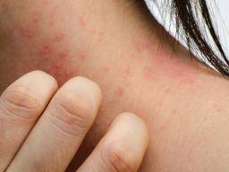 Eczema podría tratarse con una proteína de embarazo