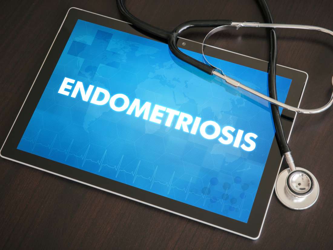 Endometriose erhöht Risiko von Ovarial-, Nieren-und Schilddrüsenkrebs
