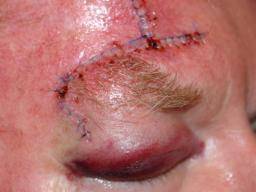Kämpfe und Stürze sind Hauptursachen für Augenverletzungen in den USA