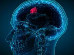 Glioblastoma: ¿un nuevo tratamiento para este tumor cerebral mortal?