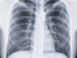 Vetsí riziko celozivotního vývoje COPD nez selhání srdce a mnoho rakovin