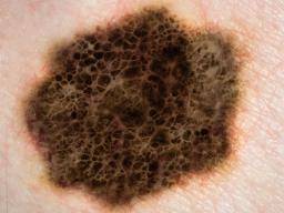 Un traitement révolutionnaire utilise l'herpès pour lutter contre le cancer de la peau