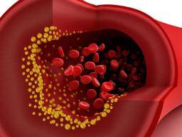 Hoher Cholesterinspiegel im Zusammenhang mit Unfruchtbarkeit