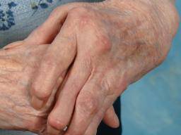 Comment gérez-vous l'arthrite dans les mains?