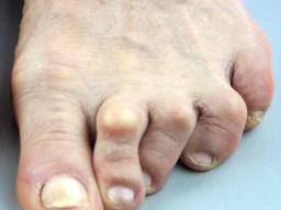 Comment l'arthrite est-elle traitée dans les orteils?