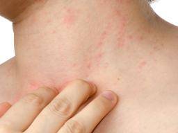 Eczema infectado: lo que necesita saber