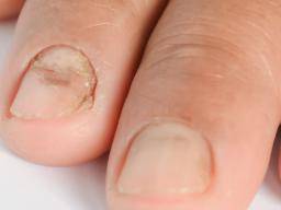 Est-ce le psoriasis ou le mycète des ongles?