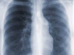 Ivacaftor verbessert Lungenfunktion und Symptome bei Patienten mit zystischer Fibrose mit spezifischer genetischer Mutation