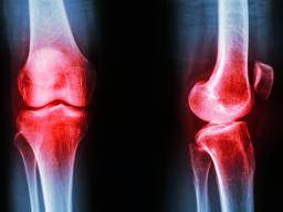 Knee osteoartróza: Steroidní injekce nenabízejí zádný prínos, tvrdí studie