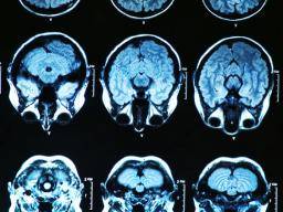 Pozdní a casný nástup Alzheimerovy choroby ovlivnuje funkci mozku podobným zpusobem