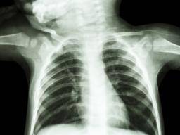 Lebenslanges Krebsrisiko durch Röntgenstrahlen für Kinder "relativ gering"